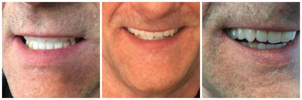Precision Complete Upper Denture And Partial Lower Denture Kelowna