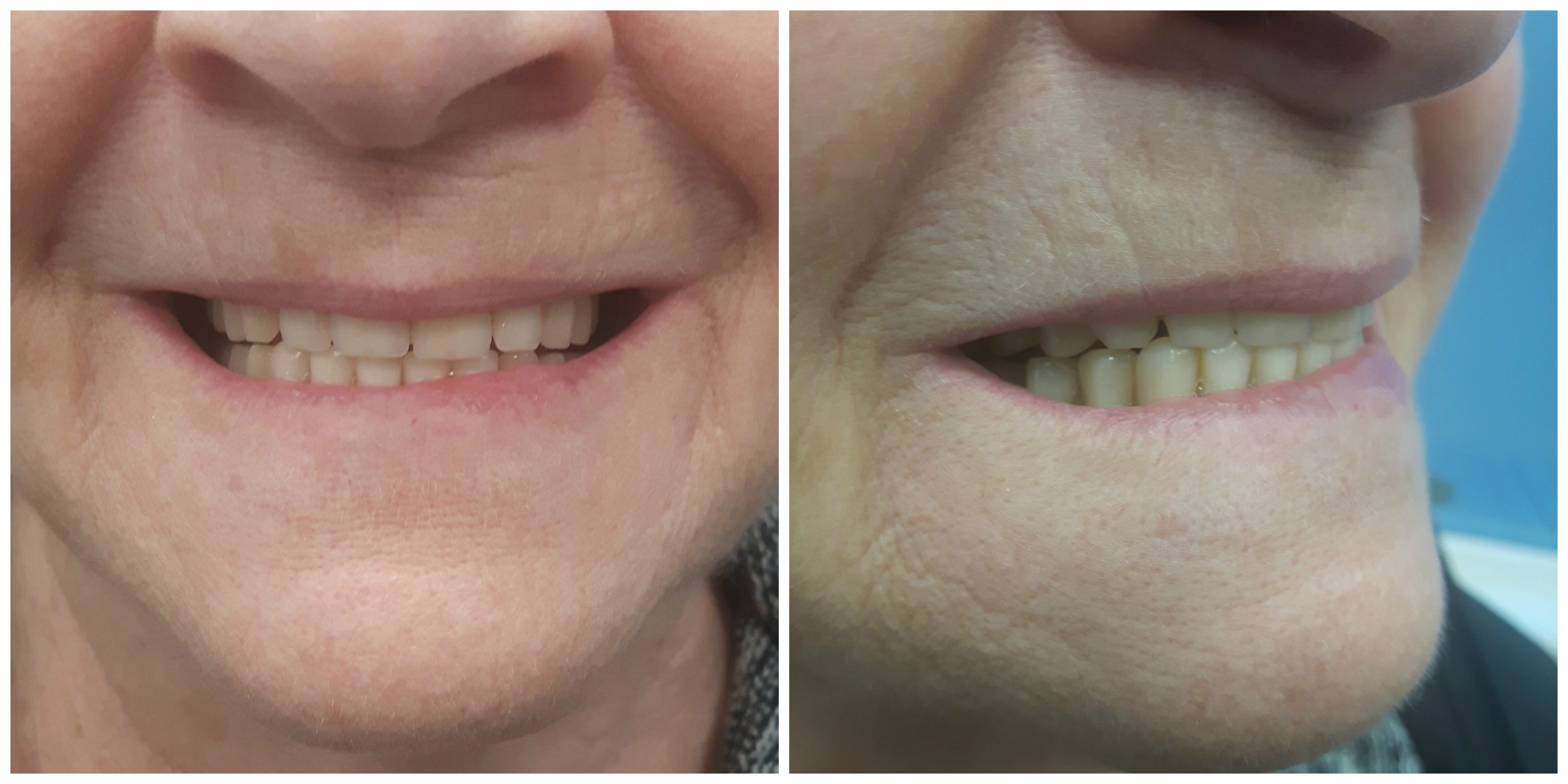 Precision Complete Upper & Lower Dentures Kelowna Denture Clinic