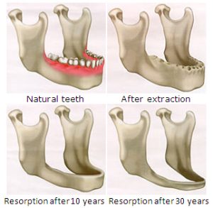 A chart outlining the progression of bone loss after tooth extractions